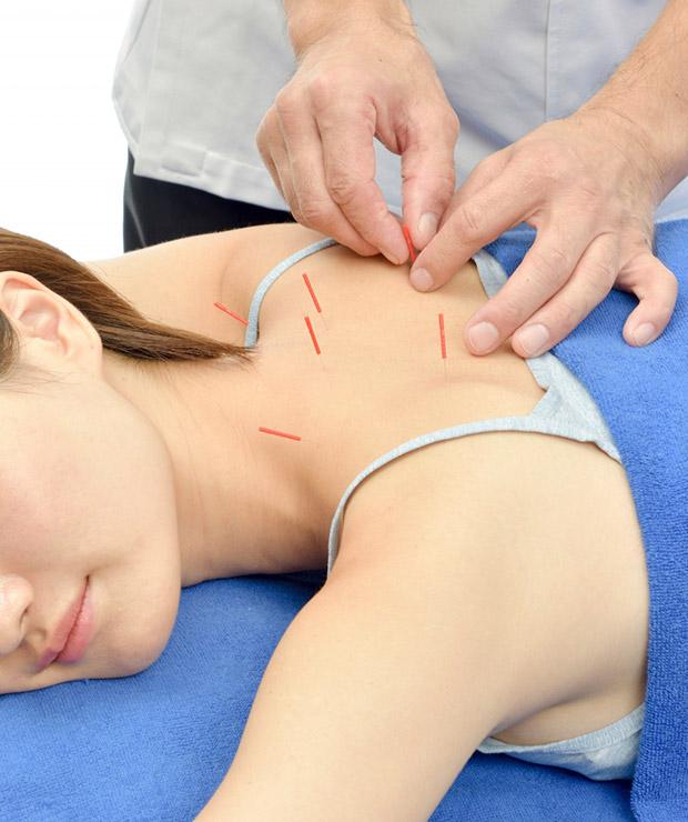 鍼･美容鍼のイメージ