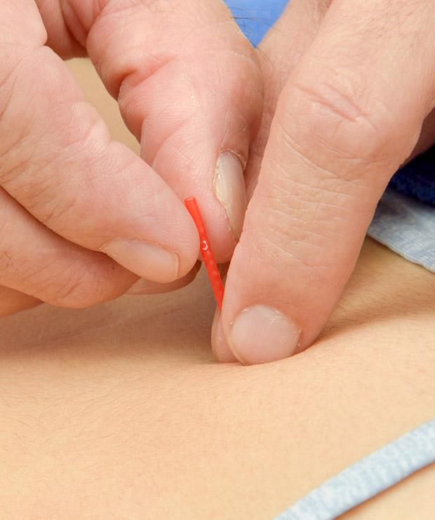 鍼･美容鍼のイメージ